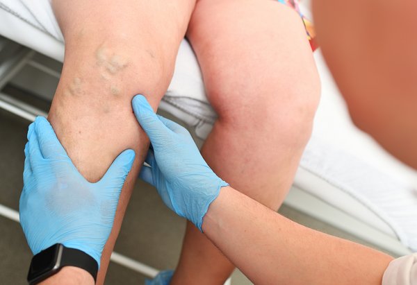 UKM Presse | Venenprobleme bei Vielsitzern